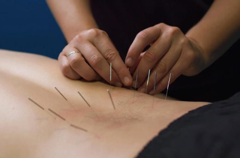 Understanding Dry Needling Treatment and Its Key Benefits