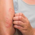 Unraveling Eczema: Insights, Tips, and Treatment Options